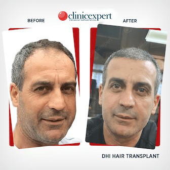 DHI Hair Transplant- Before and After results