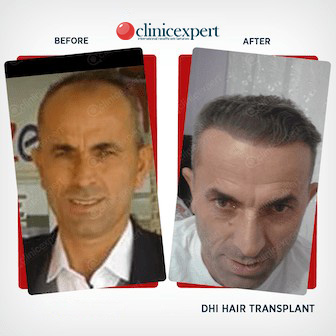Before and After-Hair Transplant -DHI