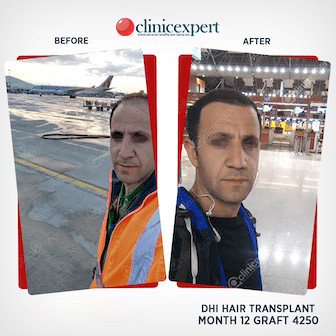 DHI Hair Transplant-12 months- 4250 Grafts