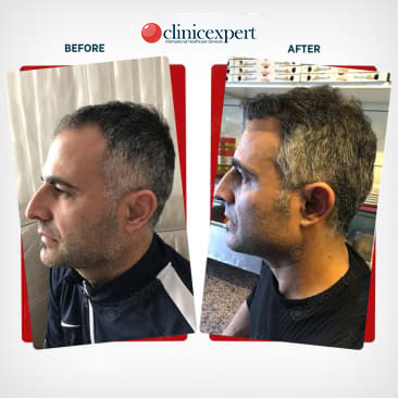 Hair Transplant-DHI-Before and After