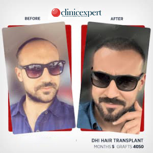 DHI Hair transplant-5 months-4050Grafts