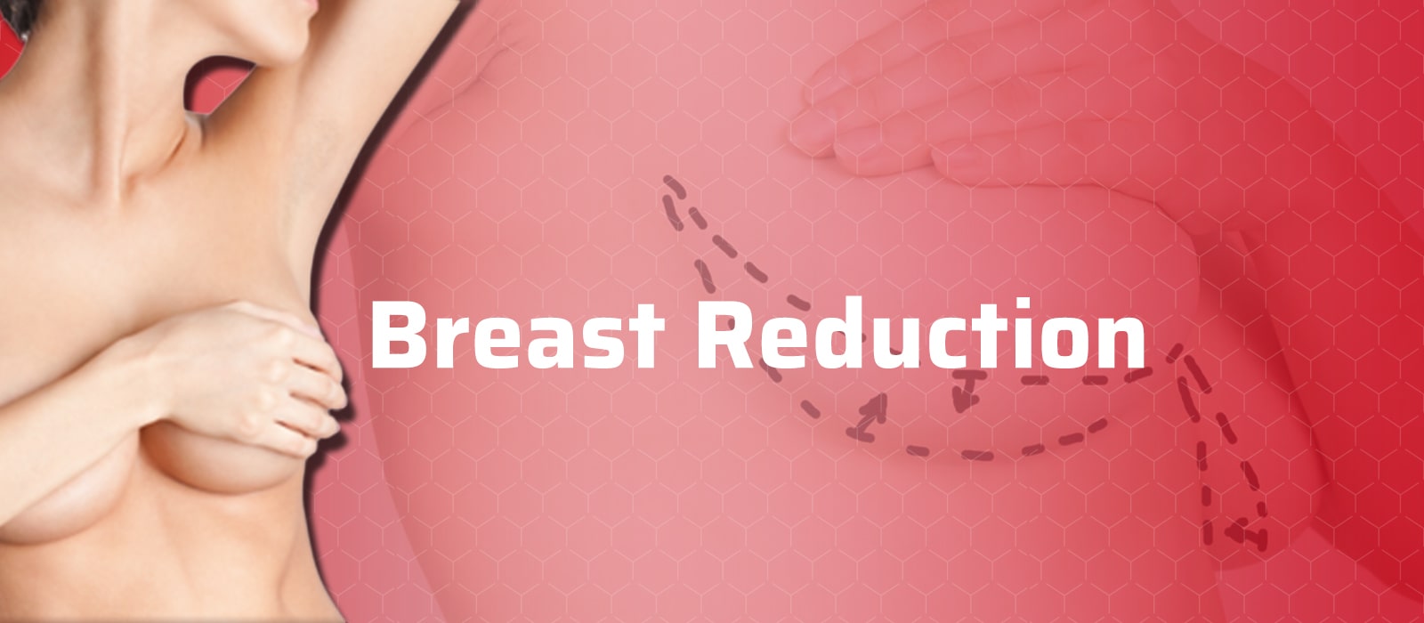 Breast Reduction
