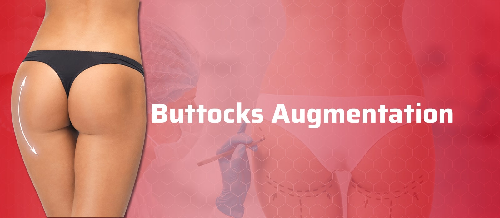 Buttocks Augmentation