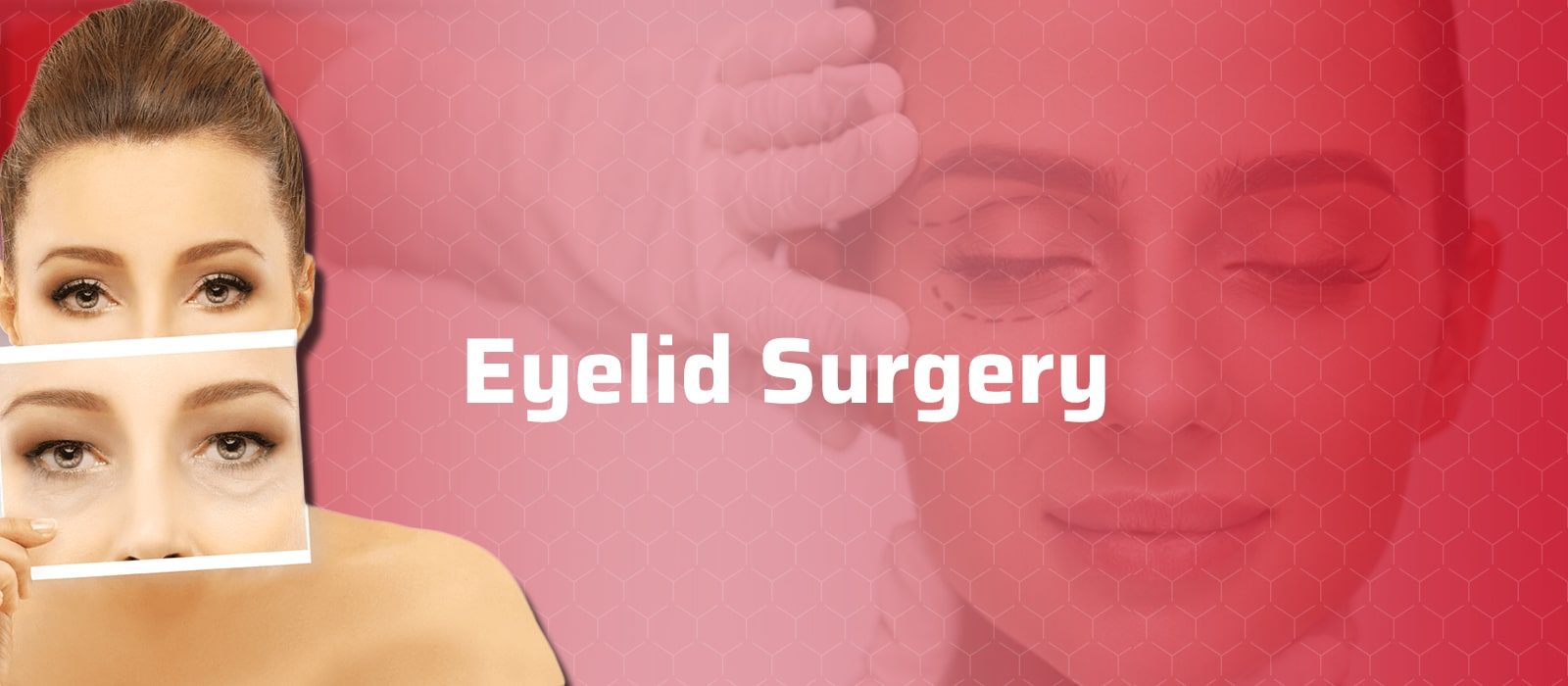eyelid surgery turkey