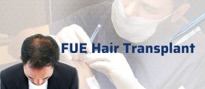 Fue Hair Transplant