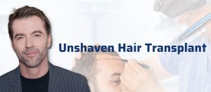 Unshaven hair transplant