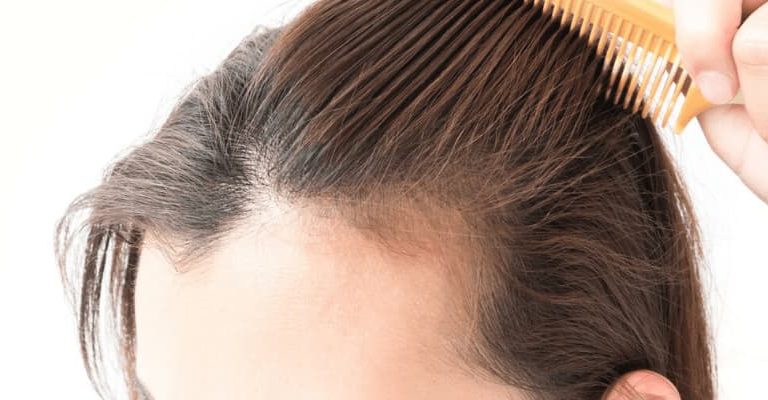 Hair Loss Causes