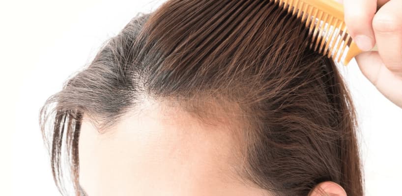 Hair Loss Causes