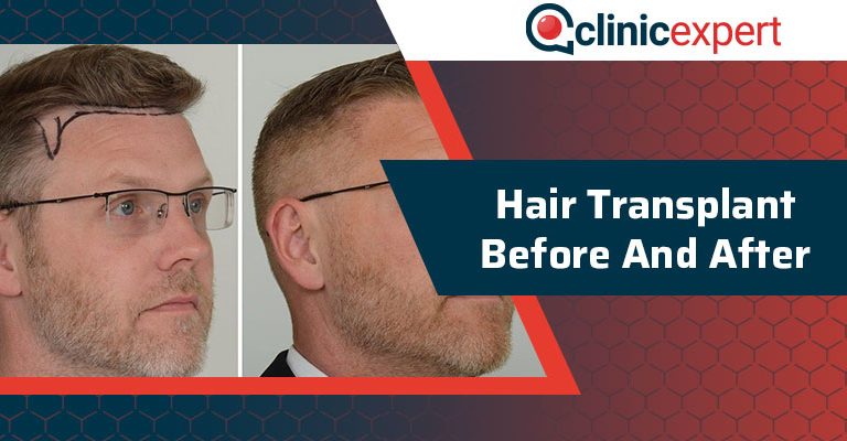 Hair Transplant Before and After