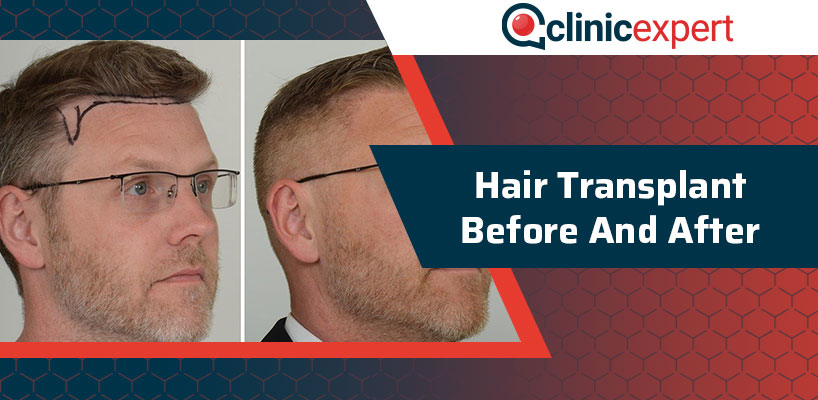 Hair Transplant Before and After