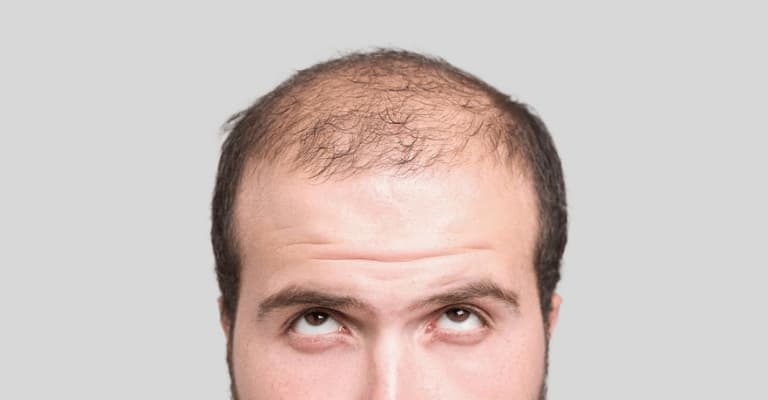 Hair Transplant Grafts: Do I Need 7000 Grafts?