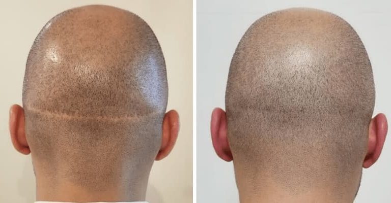 Hair Transplant Scars