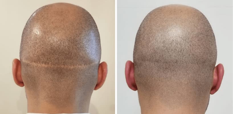 Hair Transplant Scars