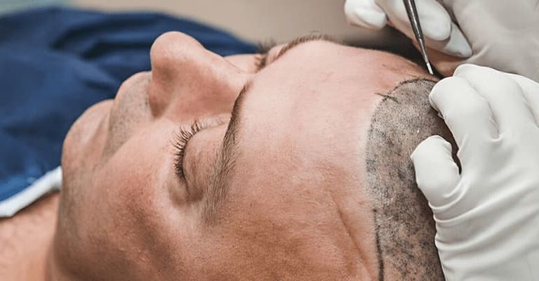 hair transplant surgery from start to finish