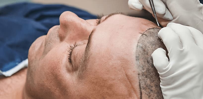 hair transplant surgery from start to finish
