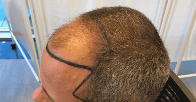 How Much is a Hair Transplant? | ClinicExpert Services