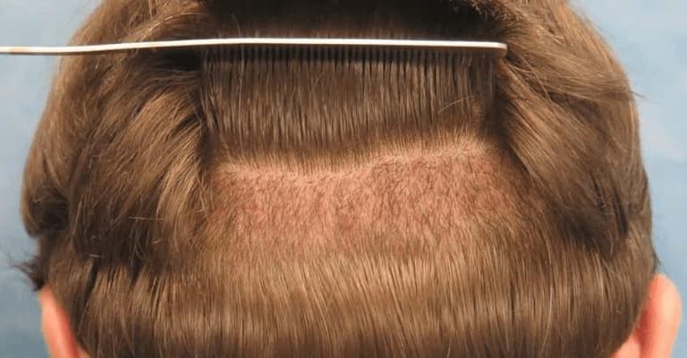 Natural Hair Transplant