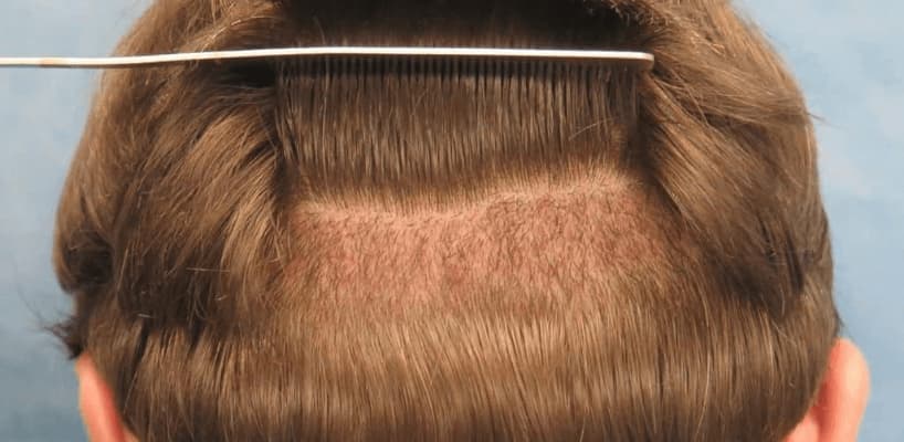 Natural Hair Transplant