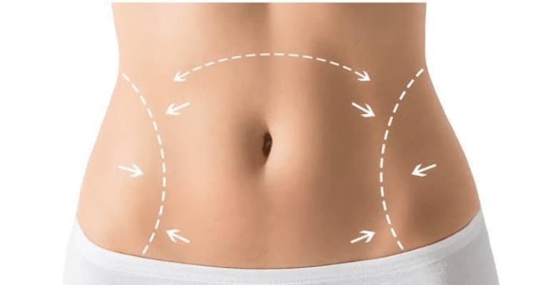 Body Lift Surgery