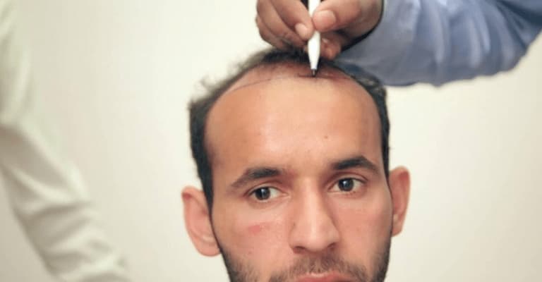 Dhi Hair Transplant Turkey