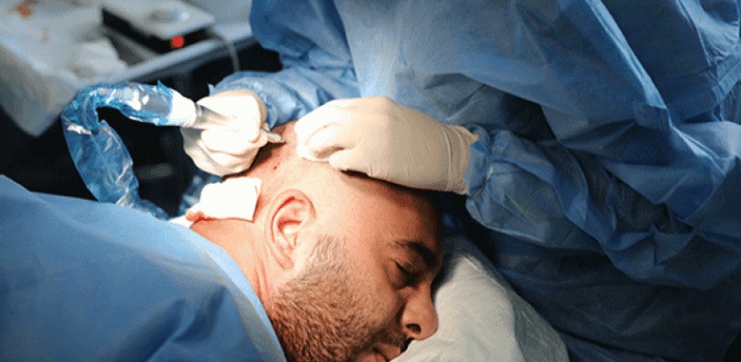 Does Hair Transplants Work?