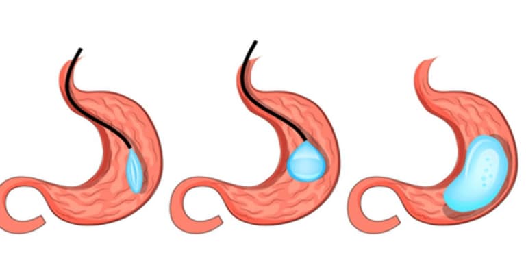 Gastric Balloon Process