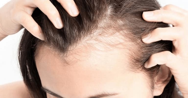 Hair Loss In Women