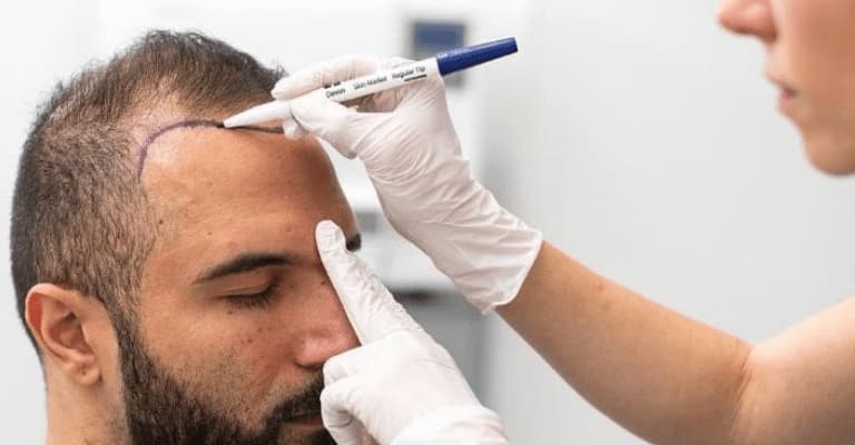 Hair Transplant Cost