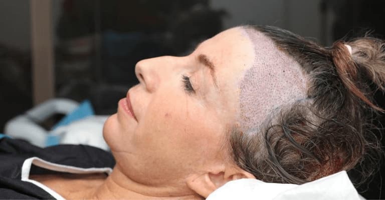 Hair Transplant For Women | ClinicExpert Services