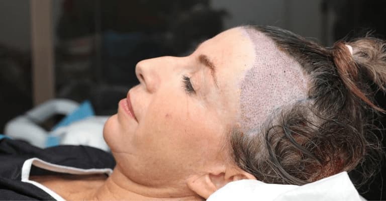 What does the Female Hair Transplant Cost in India  Regrow