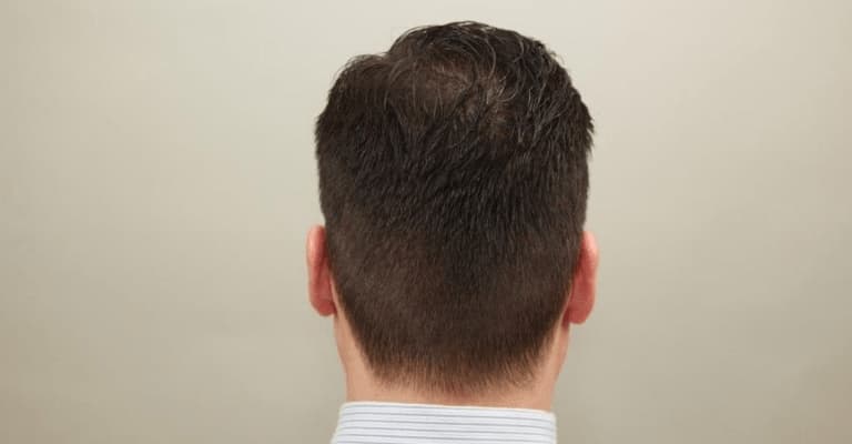 Hair Transplant Recovery Process