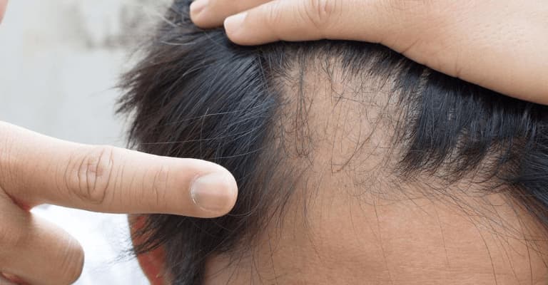 How To Stop Hair Loss