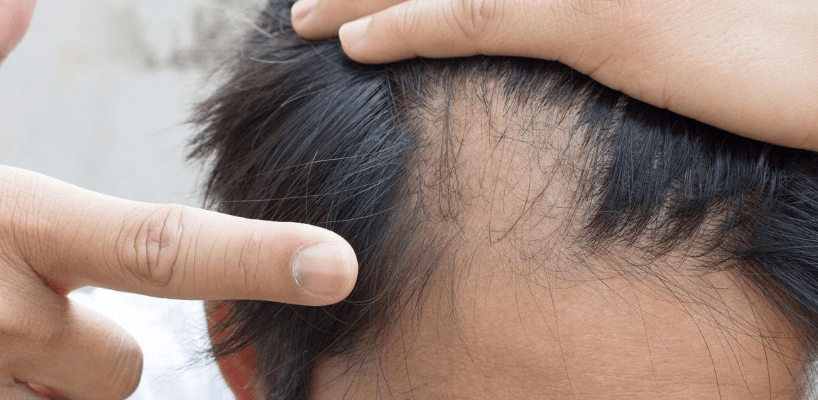Ways to stop balding