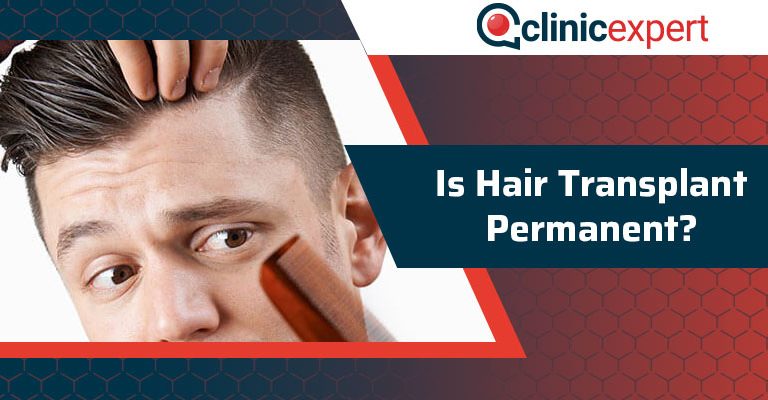 Is Hair Transplant Permanent?