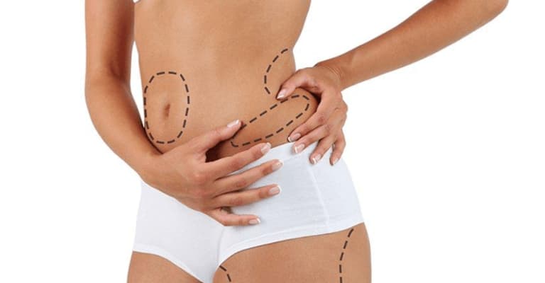 Liposuction Process