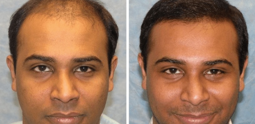 Best Hair Transplant Surgery