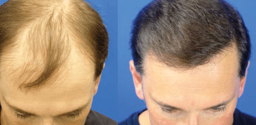 Best Hairline Transplant Surgeon