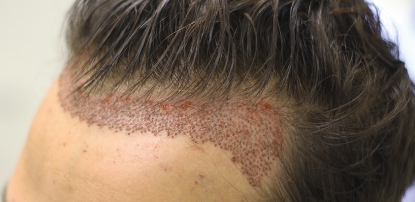 Can I Use Hair Fibres After Hair Transplant?