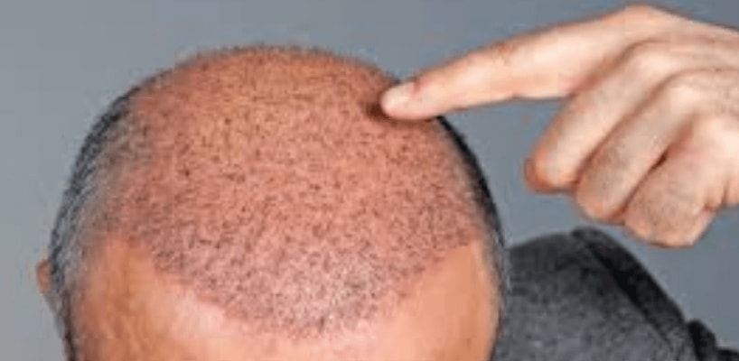 Hair Loss Replacement Surgery