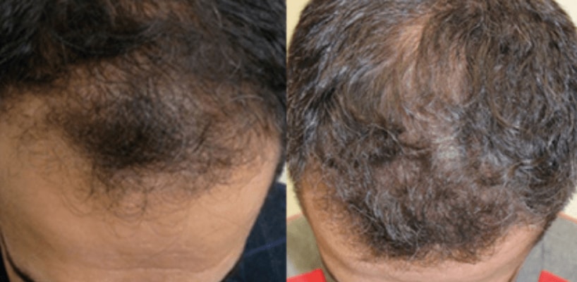 Hair Reconstruction Procedure