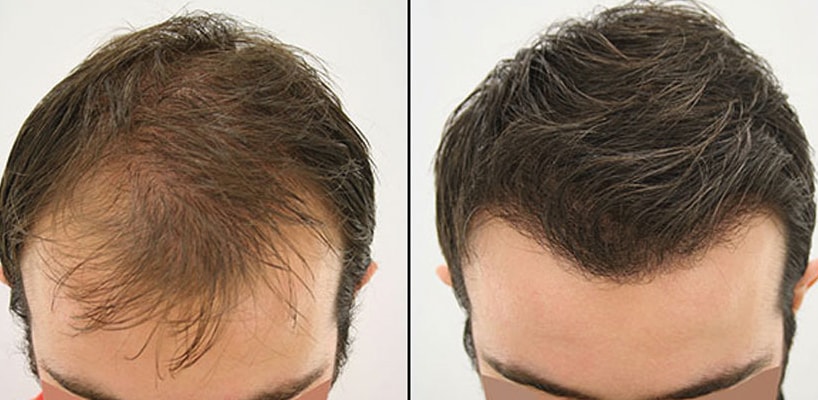 Hair transplants in Turkey: low cost, high quality - ABC Money