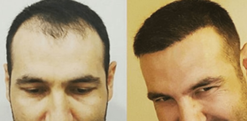How Much is a Hair Transplant in Turkey | Clinicexpert