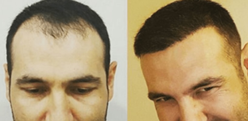 HAIR TRANSPLANT IN TURKEY 6 MONTHS RESULTS aged 44 - Things You NEED TO  KNOW - YouTube