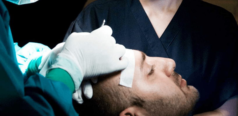 How to Find a Good Hair Transplant Surgeon?