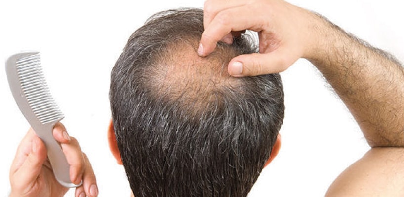 How to Stop Hair Loss in Men?