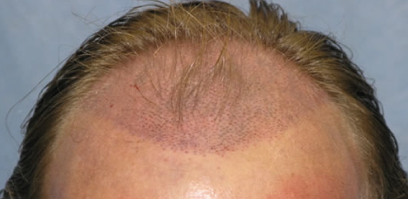 Men's Hair Transplant Surgery