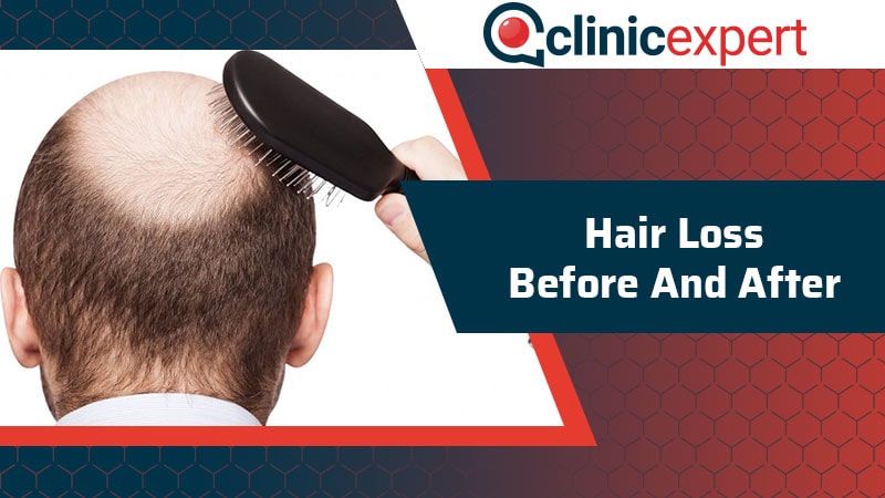 Hair Loss Before and After