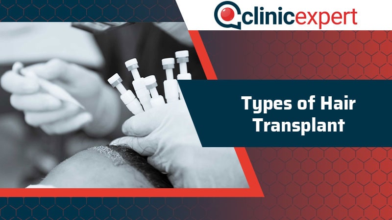 Types of Hair Transplant