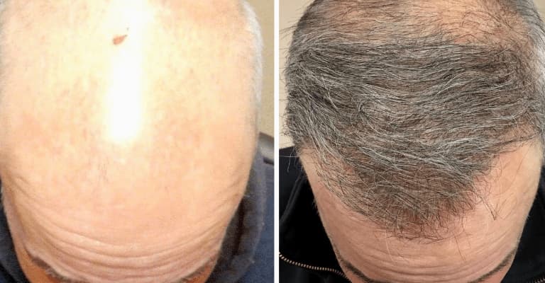 Hair Follicle Surgery