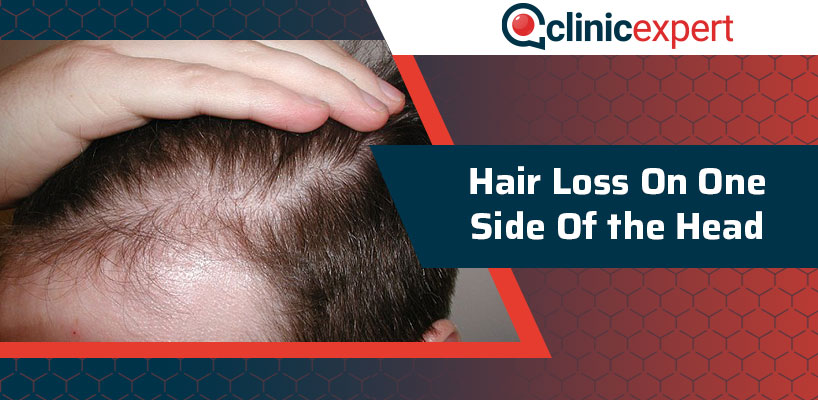 Hair Loss On One Side of the Head | ClinicExpert